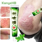 1 Psoriasis Ointment Dermatitis Eczema Urticaria Desquamation Treatment Cream Skin Care Antibacterial Medical (New)